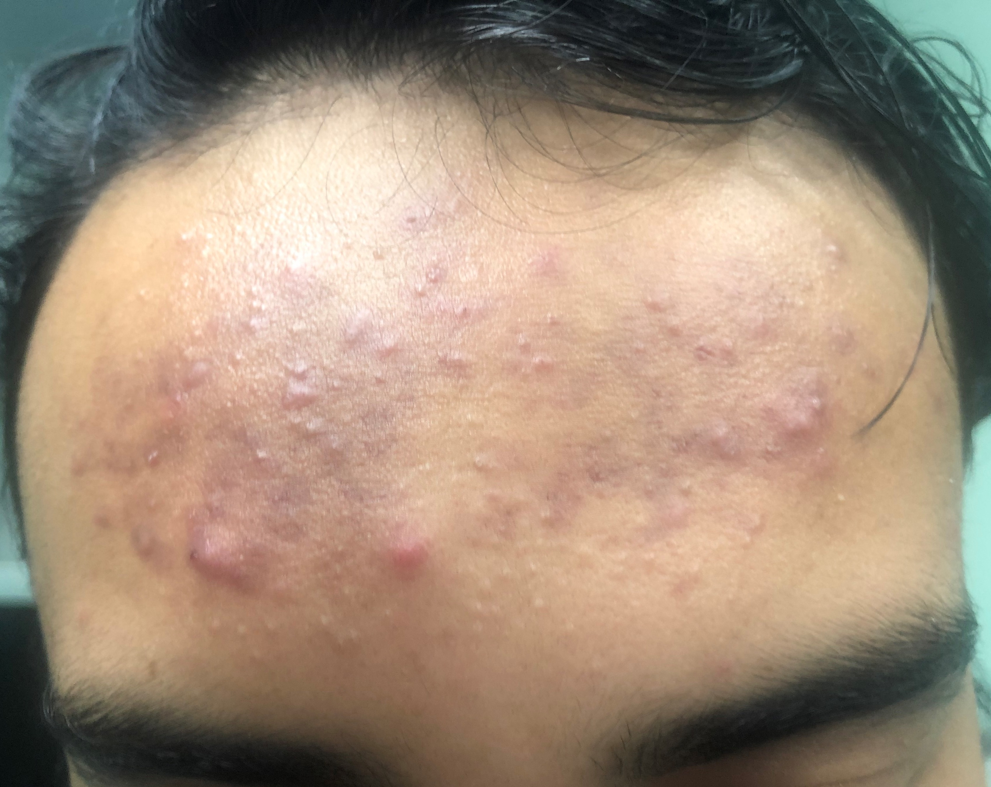 Casos de Acné - Antes y Después de Peelings